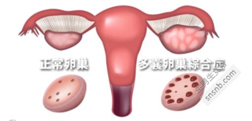 谱系：多囊卵巢综合症的症状是什么？