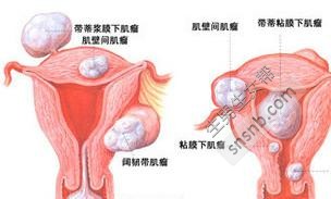 导致女性不孕的宫颈疾病有哪些