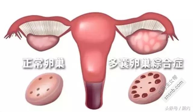 得了多囊卵巢综合症如何才能快速、轻松地怀孕？