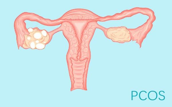 合肥供卵试管生小孩-多囊症患者可以通过试管婴儿怀孕吗？我应该如何管理我的身体？