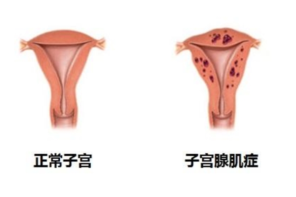 子宫腺肌症