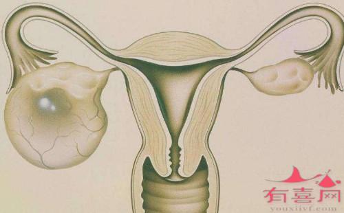 深圳合法供卵包生子多少钱：卵巢囊腺瘤是否影响卵子的发育？